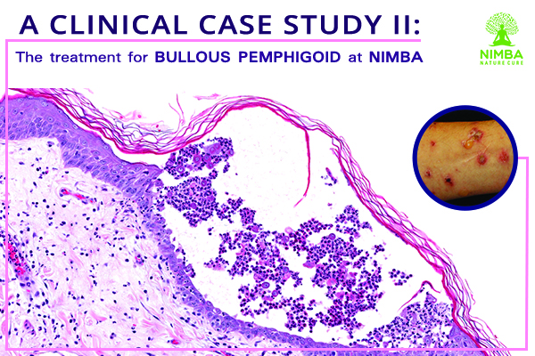 Treatment for Bullous Pemphigoid at Nimba