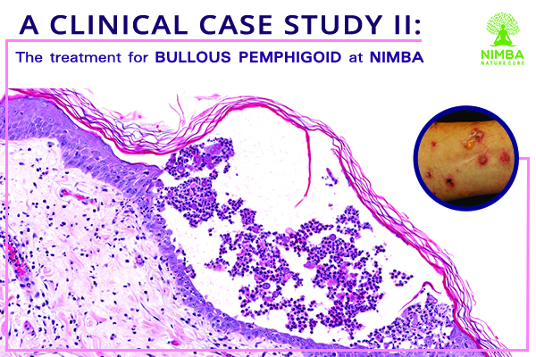 [Clinical Case Study II] The treatment for Bullous Pemphigoid at Nimba