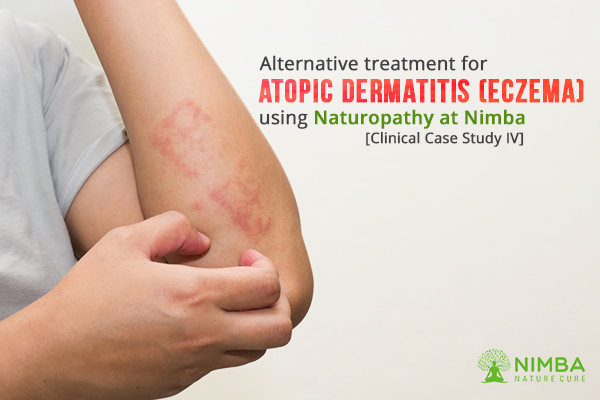 [Case Study IV] Alternative treatment for Atopic Dermatitis (Eczema) using Naturopathy at Nimba