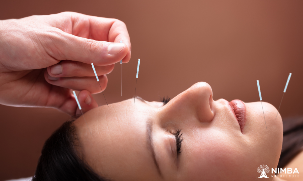 Acupuncture